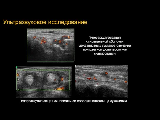 Ультразвуковое исследование Гипераскуляризация синовиальной оболочки межзапястных суставов-свечение при цветном допплеровском сканировании Гиперваскуляризация синовиальной оболочки влагалища сухожилий