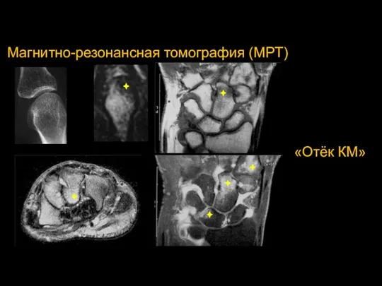 Магнитно-резонансная томография (МРТ) «Отёк КМ»