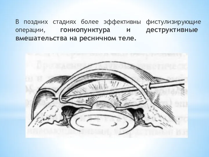 В поздних стадиях более эффективны фистулизирующие операции, гониопунктура и деструктивные вмешательства на ресничном теле.