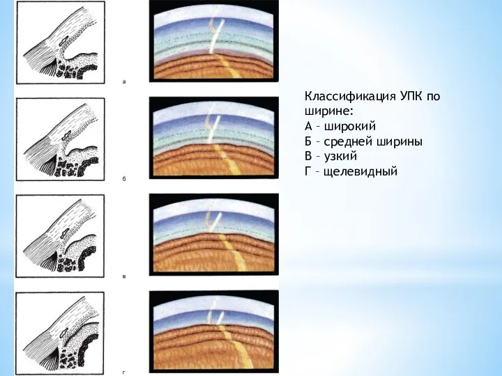 Классификация УПК по ширине: А – широкий Б – средней