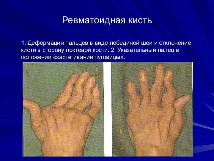 Ревматоидная кисть 1. Деформация пальцев в виде лебединой шеи и отклонение кисти в