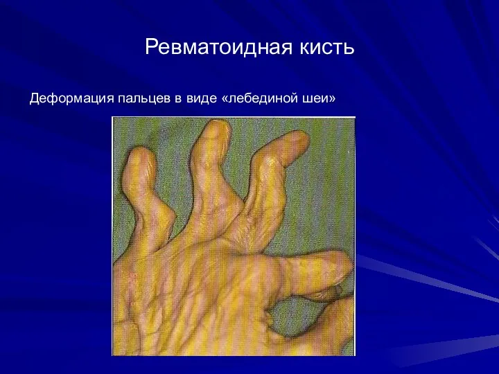 Ревматоидная кисть Деформация пальцев в виде «лебединой шеи»