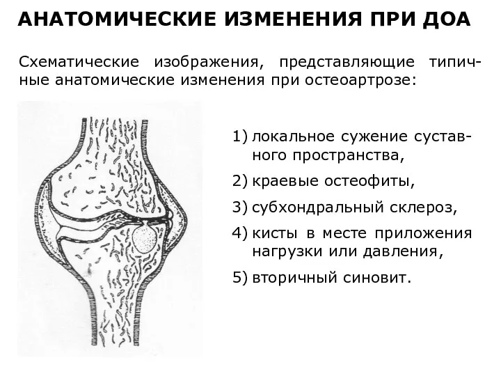 Схематические изображения, представляющие типич-ные анатомические изменения при остеоартрозе: АНАТОМИЧЕСКИЕ ИЗМЕНЕНИЯ ПРИ ДОА 1)