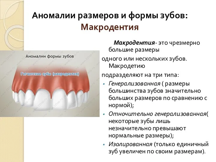 Аномалии размеров и формы зубов: Макродентия Макродентия- это чрезмерно большие размеры одного или