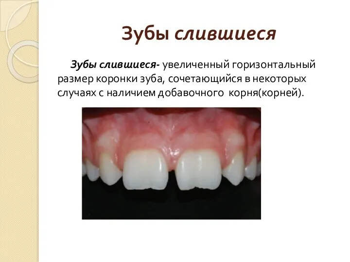 Зубы слившиеся Зубы слившиеся- увеличенный горизонтальный размер коронки зуба, сочетающийся в некоторых случаях