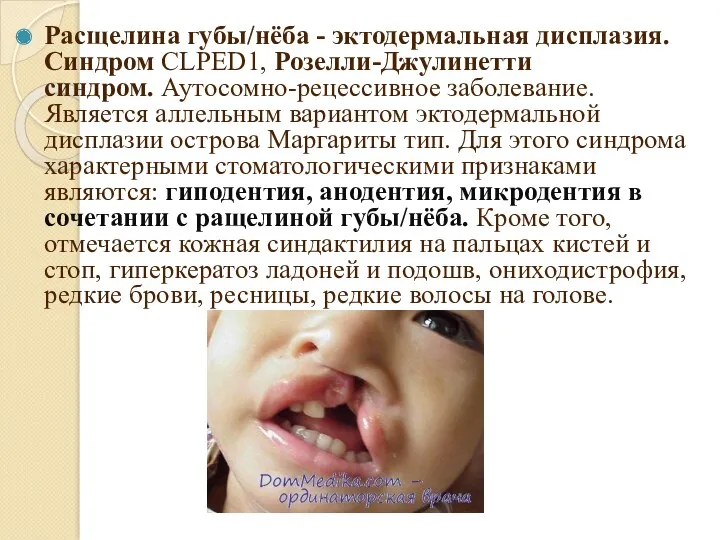Расщелина губы/нёба - эктодермальная дисплазия. Синдром CLPED1, Розелли-Джулинетти синдром. Аутосомно-рецессивное заболевание. Является аллельным