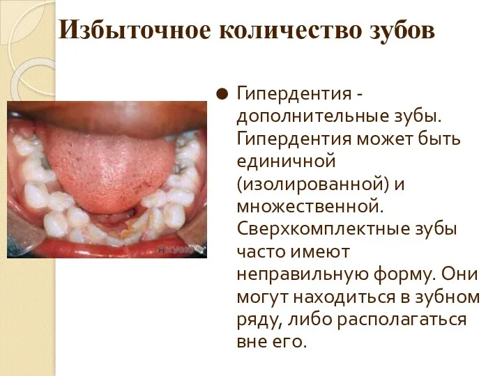 Избыточное количество зубов Гипердентия - дополнительные зубы. Гипердентия может быть единичной (изолированной) и