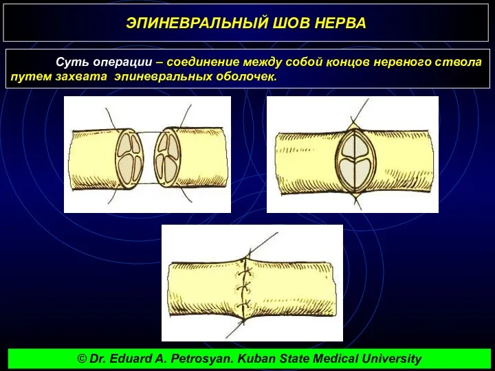 ЭПИНЕВРАЛЬНЫЙ ШОВ НЕРВА Суть операции – соединение между собой концов нервного ствола путем