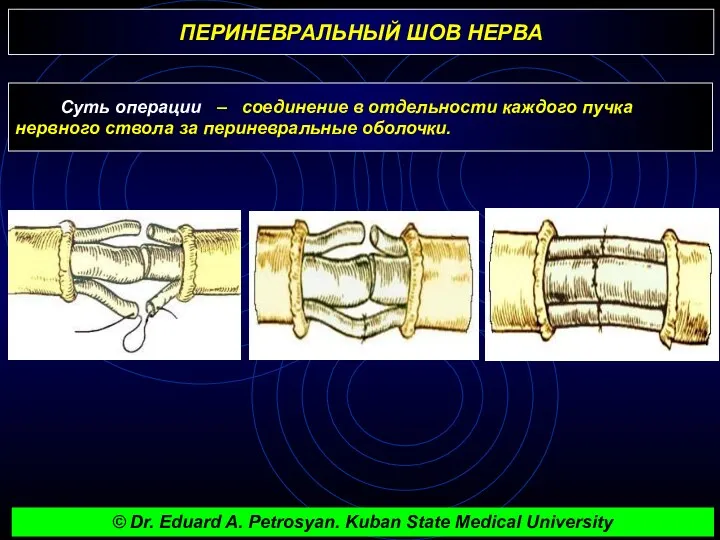 ПЕРИНЕВРАЛЬНЫЙ ШОВ НЕРВА Суть операции – соединение в отдельности каждого пучка нервного ствола