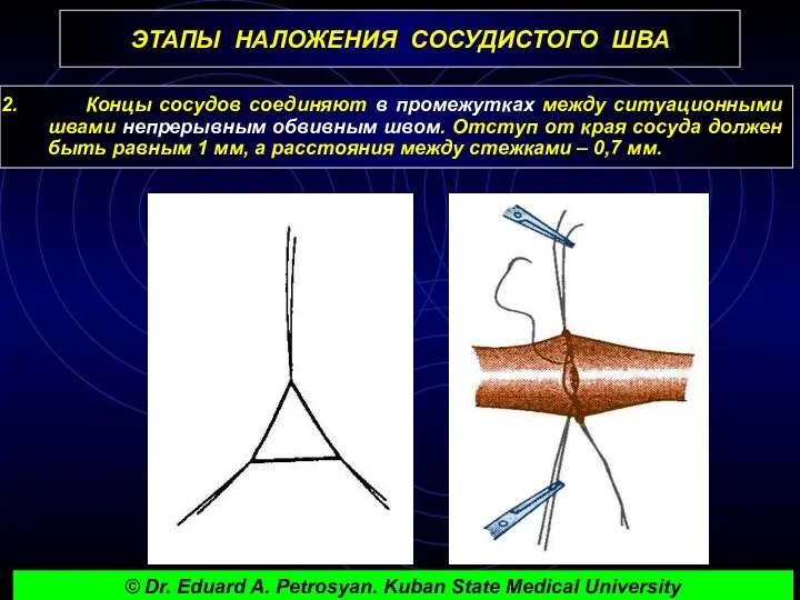 ЭТАПЫ НАЛОЖЕНИЯ СОСУДИСТОГО ШВА Концы сосудов соединяют в промежутках между ситуационными швами непрерывным