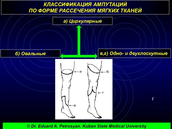 КЛАССИФИКАЦИЯ АМПУТАЦИЙ ПО ФОРМЕ РАССЕЧЕНИЯ МЯГКИХ ТКАНЕЙ г а) Циркулярные б) Овальные в,г)