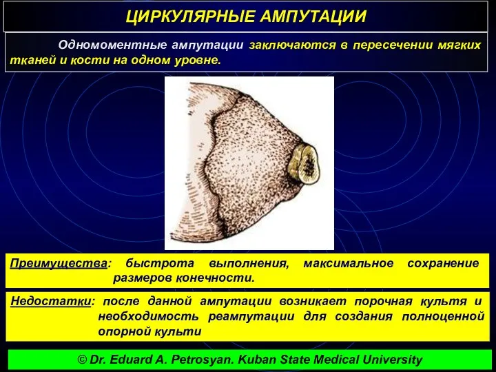 ЦИРКУЛЯРНЫЕ АМПУТАЦИИ г Одномоментные ампутации заключаются в пересечении мягких тканей и кости на