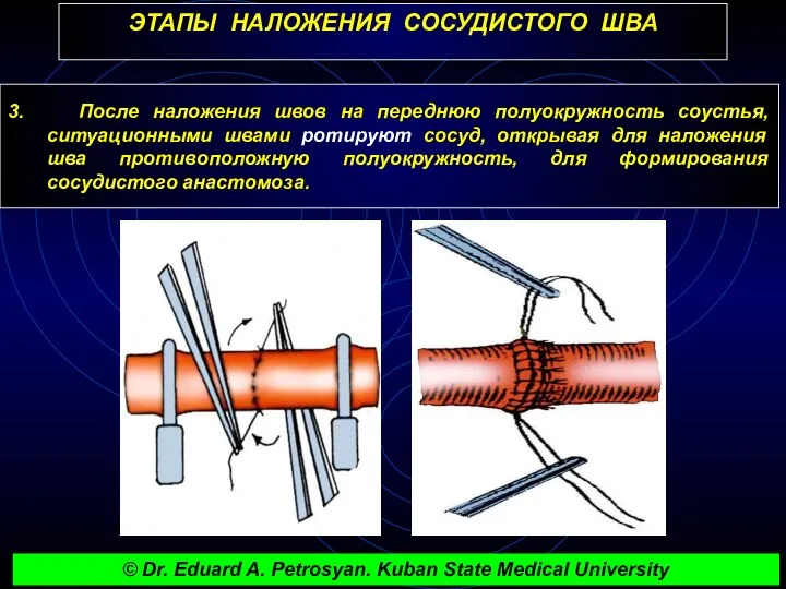 ЭТАПЫ НАЛОЖЕНИЯ СОСУДИСТОГО ШВА 3. После наложения швов на переднюю полуокружность соустья, ситуационными