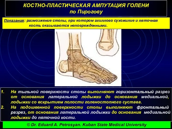 КОСТНО-ПЛАСТИЧЕСКАЯ АМПУТАЦИЯ ГОЛЕНИ по Пирогову Показания: размозжение стопы, при котором ахиллово сухожилие и