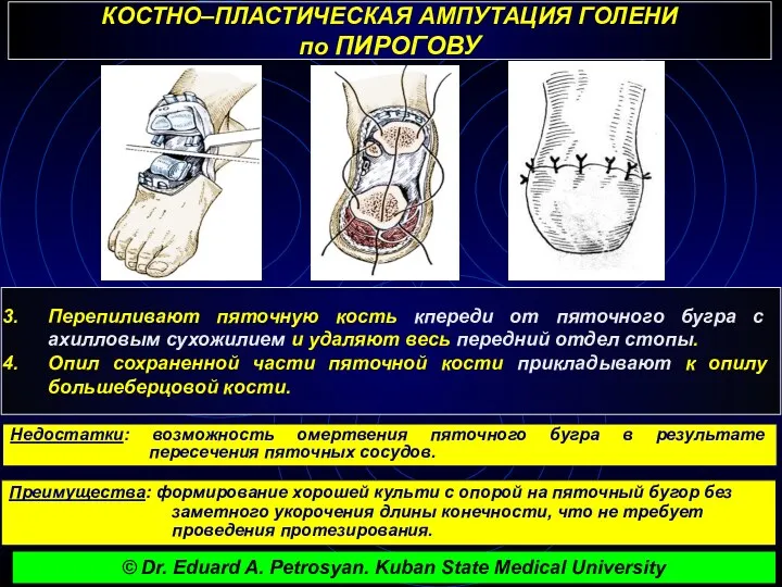 КОСТНО–ПЛАСТИЧЕСКАЯ АМПУТАЦИЯ ГОЛЕНИ по ПИРОГОВУ Перепиливают пяточную кость кпереди от пяточного бугра с