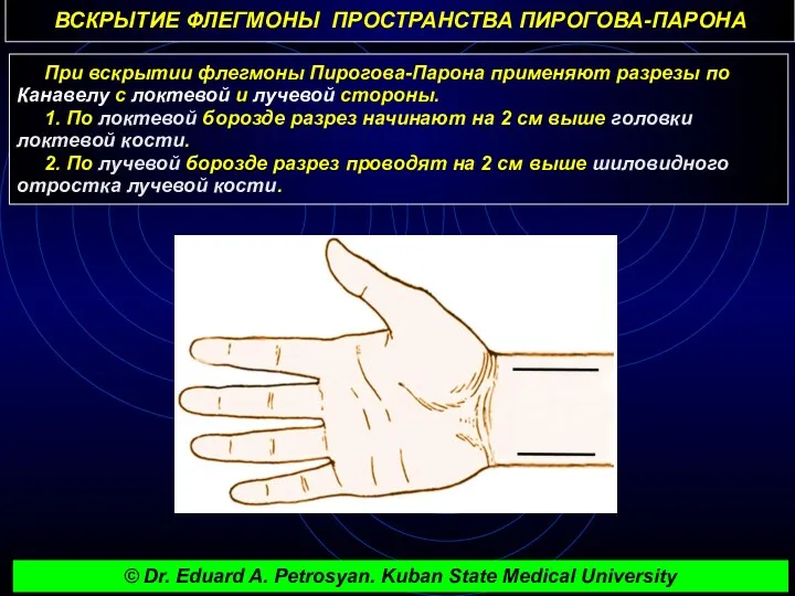 ВСКРЫТИЕ ФЛЕГМОНЫ ПРОСТРАНСТВА ПИРОГОВА-ПАРОНА При вскрытии флегмоны Пирогова-Парона применяют разрезы по Канавелу с