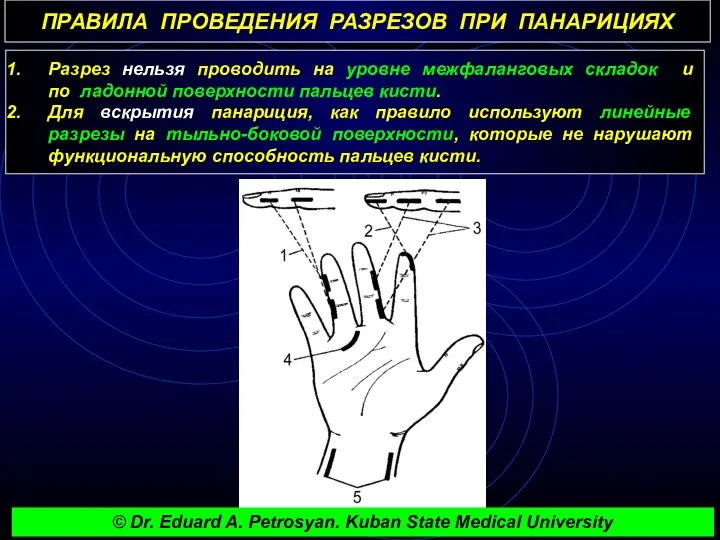 ПРАВИЛА ПРОВЕДЕНИЯ РАЗРЕЗОВ ПРИ ПАНАРИЦИЯХ Разрез нельзя проводить на уровне межфаланговых складок и