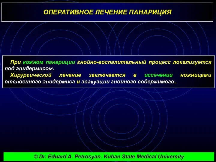 ОПЕРАТИВНОЕ ЛЕЧЕНИЕ ПАНАРИЦИЯ При кожном панариции гнойно-воспалительный процесс локализуется под эпидермисом. Хирургической лечение