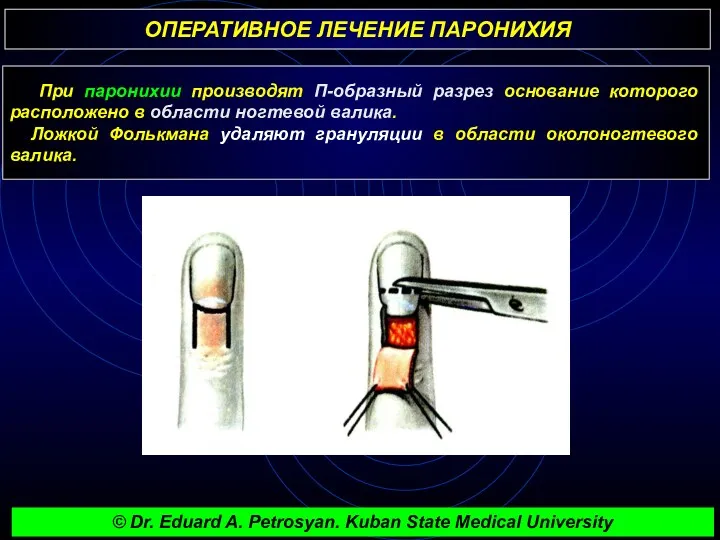 ОПЕРАТИВНОЕ ЛЕЧЕНИЕ ПАРОНИХИЯ При паронихии производят П-образный разрез основание которого расположено в области