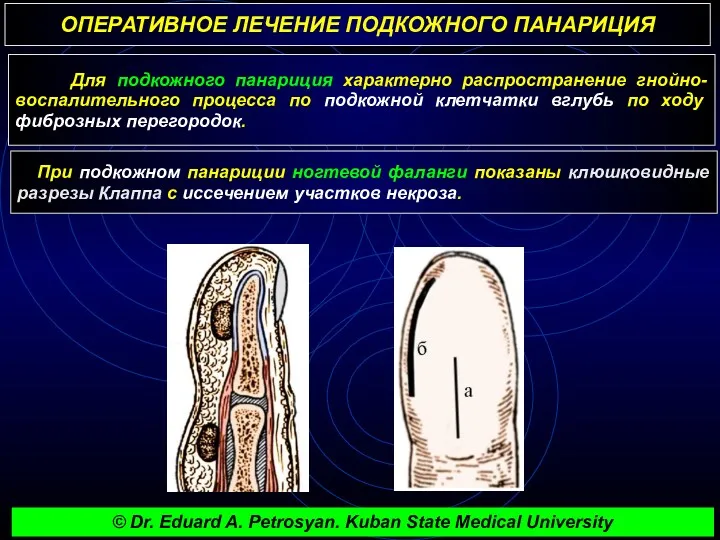 ОПЕРАТИВНОЕ ЛЕЧЕНИЕ ПОДКОЖНОГО ПАНАРИЦИЯ Для подкожного панариция характерно распространение гнойно-воспалительного процесса по подкожной