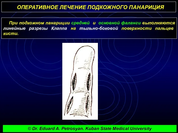 ОПЕРАТИВНОЕ ЛЕЧЕНИЕ ПОДКОЖНОГО ПАНАРИЦИЯ При подкожном панариции средней и основной фаланги выполняются линейные