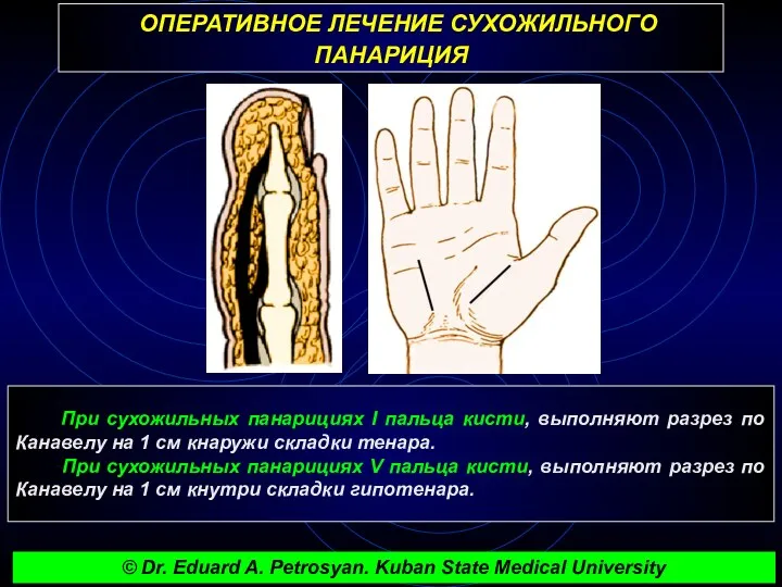 ОПЕРАТИВНОЕ ЛЕЧЕНИЕ СУХОЖИЛЬНОГО ПАНАРИЦИЯ При сухожильных панарициях I пальца кисти, выполняют разрез по