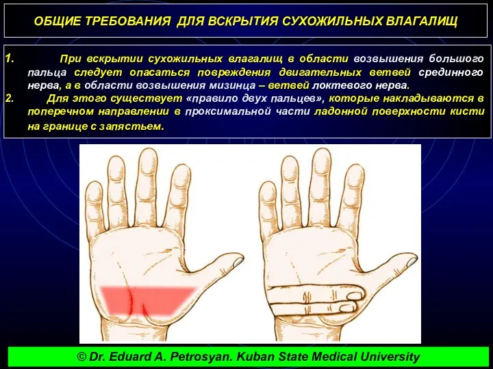 ОБЩИЕ ТРЕБОВАНИЯ ДЛЯ ВСКРЫТИЯ СУХОЖИЛЬНЫХ ВЛАГАЛИЩ При вскрытии сухожильных влагалищ в области возвышения