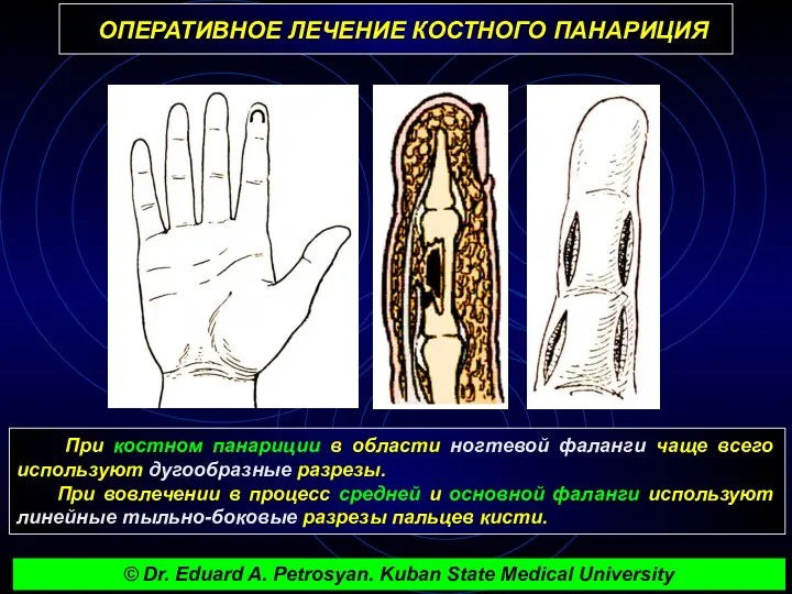 ОПЕРАТИВНОЕ ЛЕЧЕНИЕ КОСТНОГО ПАНАРИЦИЯ При костном панариции в области ногтевой фаланги чаще всего