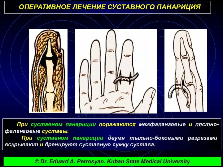 ОПЕРАТИВНОЕ ЛЕЧЕНИЕ СУСТАВНОГО ПАНАРИЦИЯ При суставном панариции поражаются межфаланговые и пястно-фаланговые суставы. При