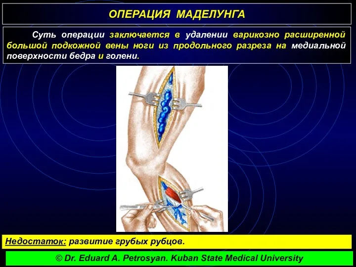ОПЕРАЦИЯ МАДЕЛУНГА Суть операции заключается в удалении варикозно расширенной большой подкожной вены ноги
