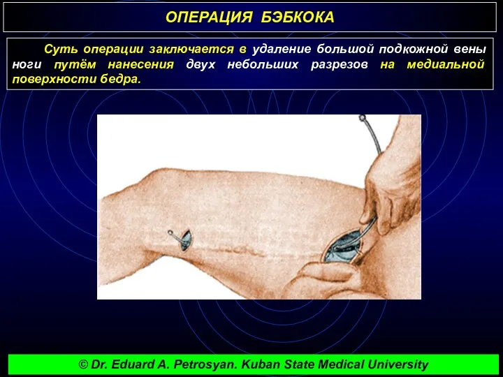 ОПЕРАЦИЯ БЭБКОКА Суть операции заключается в удаление большой подкожной вены ноги путём нанесения