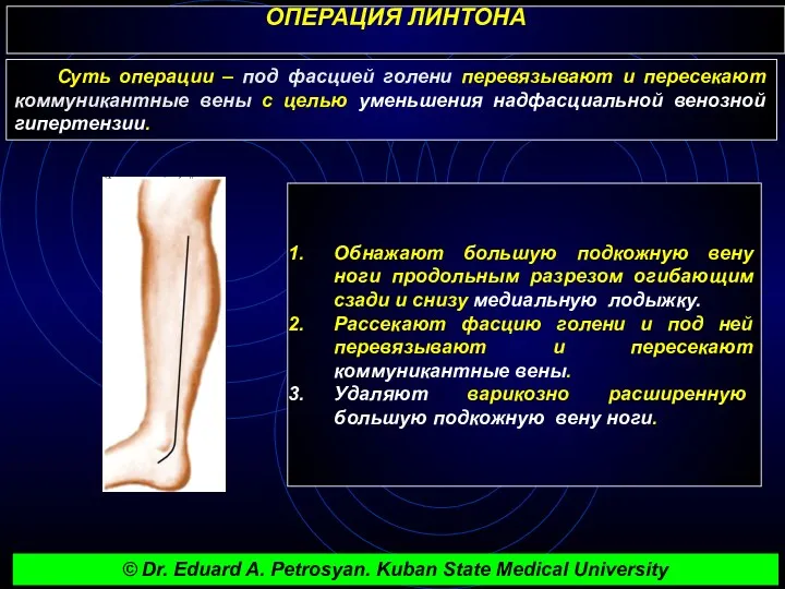 ОПЕРАЦИЯ ЛИНТОНА Обнажают большую подкожную вену ноги продольным разрезом огибающим сзади и снизу