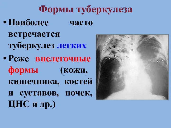 Формы туберкулеза Наиболее часто встречается туберкулез легких Реже внелегочные формы