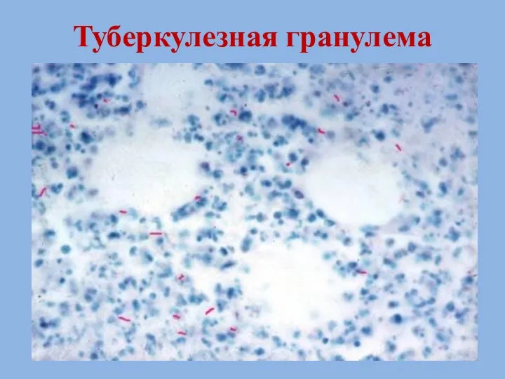 Туберкулезная гранулема
