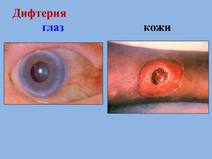 Дифтерия глаз кожи
