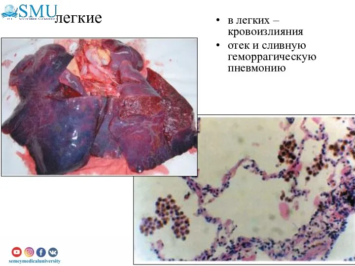 легкие в легких – кровоизлияния отек и сливную геморрагическую пневмонию