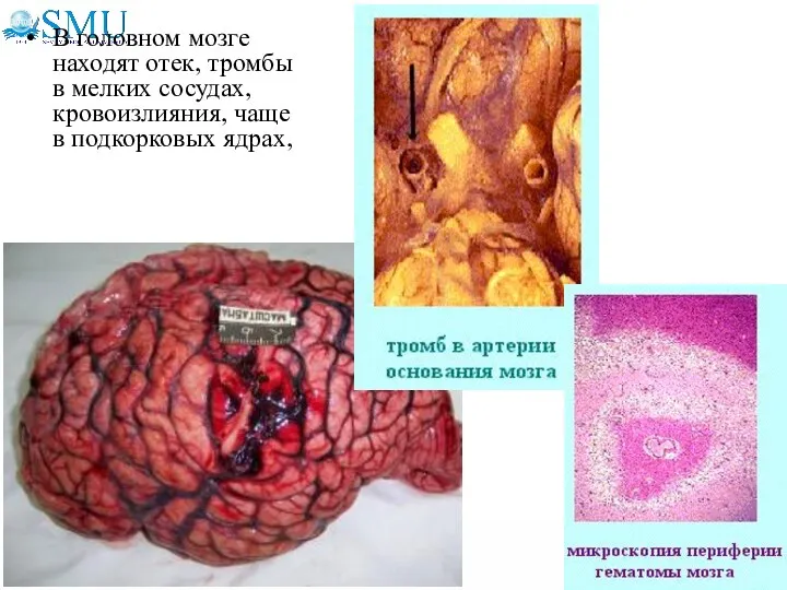 В головном мозге находят отек, тромбы в мелких сосудах, кровоизлияния, чаще в подкорковых ядрах,