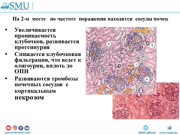 На 2-м месте по частоте поражения находятся сосуды почек Увеличивается