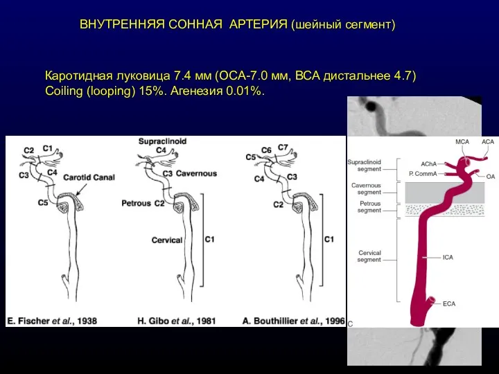 ВНУТРЕННЯЯ СОННАЯ АРТЕРИЯ (шейный сегмент) Каротидная луковица 7.4 мм (ОСА-7.0