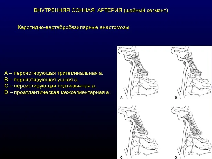 Каротидно-вертебробазилярные анастомозы А – персистирующая тригеминальная а. В – персистирующая