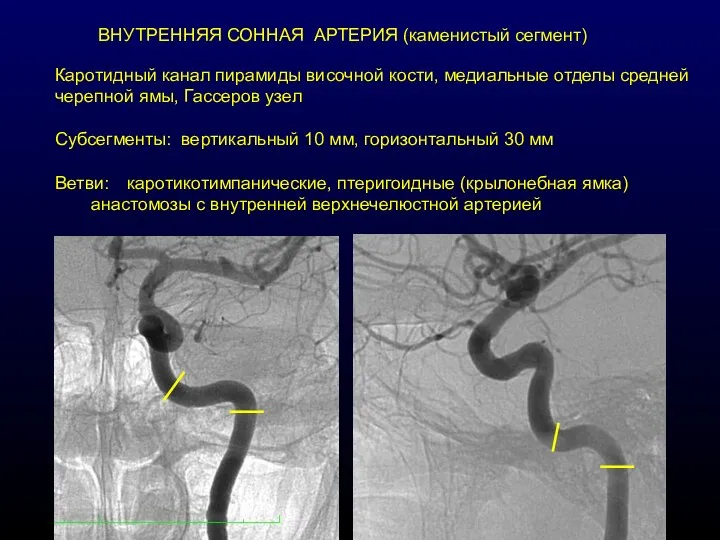 ВНУТРЕННЯЯ СОННАЯ АРТЕРИЯ (каменистый сегмент) Каротидный канал пирамиды височной кости,