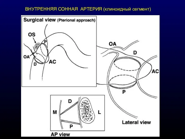 ВНУТРЕННЯЯ СОННАЯ АРТЕРИЯ (клиноидный сегмент)