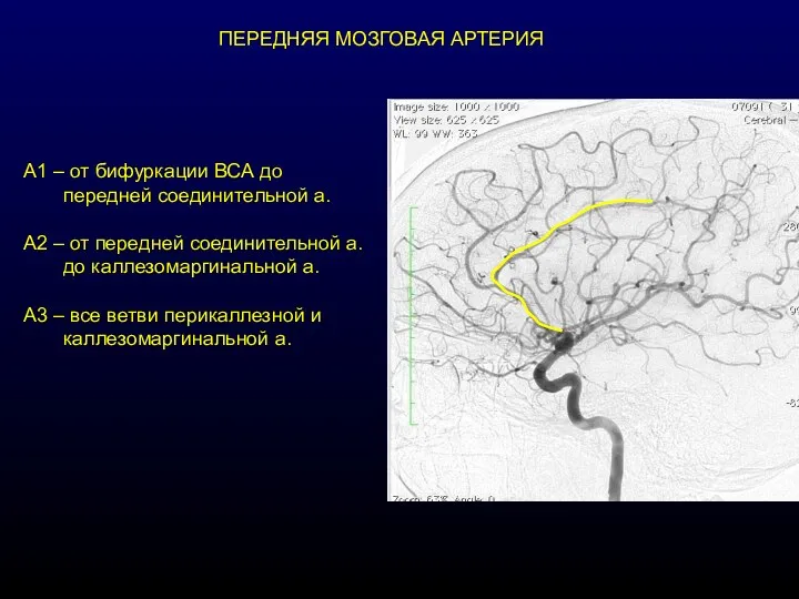 ПЕРЕДНЯЯ МОЗГОВАЯ АРТЕРИЯ А1 – от бифуркации ВСА до передней