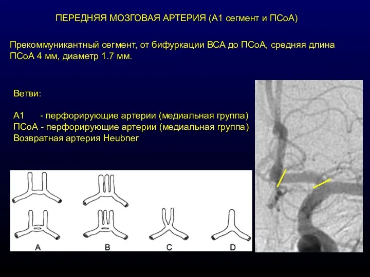 ПЕРЕДНЯЯ МОЗГОВАЯ АРТЕРИЯ (А1 сегмент и ПСоА) Прекоммуникантный сегмент, от