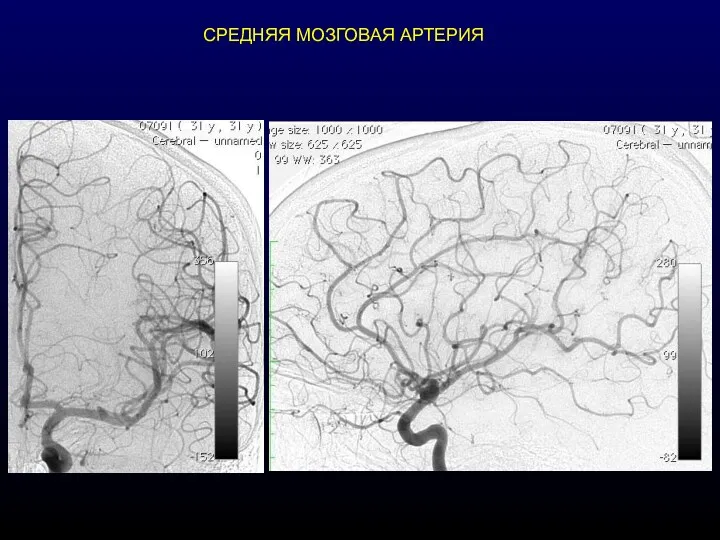 СРЕДНЯЯ МОЗГОВАЯ АРТЕРИЯ