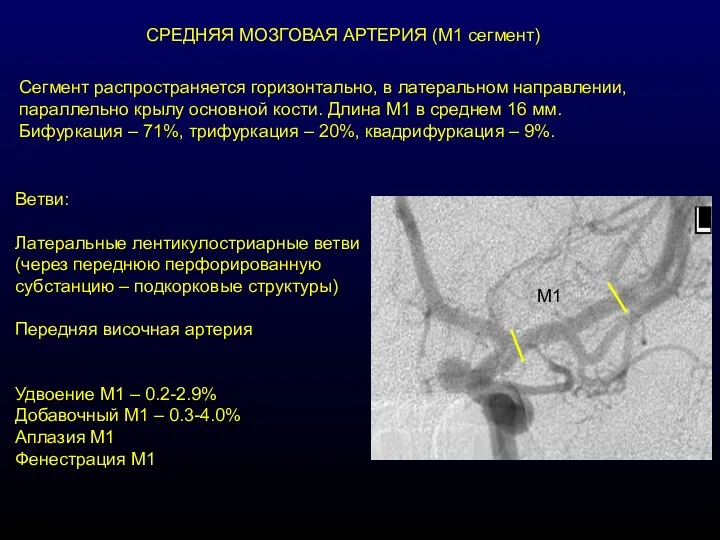 СРЕДНЯЯ МОЗГОВАЯ АРТЕРИЯ (М1 сегмент) Сегмент распространяется горизонтально, в латеральном