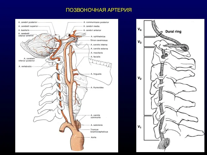 ПОЗВОНОЧНАЯ АРТЕРИЯ