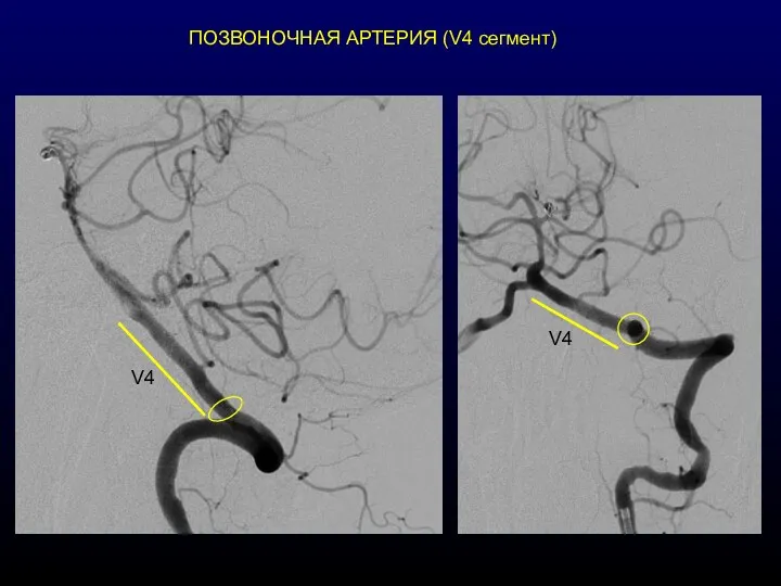 ПОЗВОНОЧНАЯ АРТЕРИЯ (V4 сегмент)