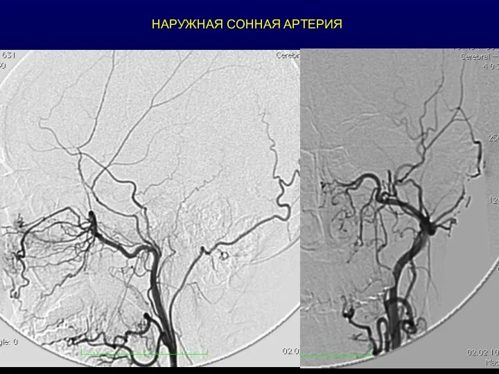 НАРУЖНАЯ СОННАЯ АРТЕРИЯ