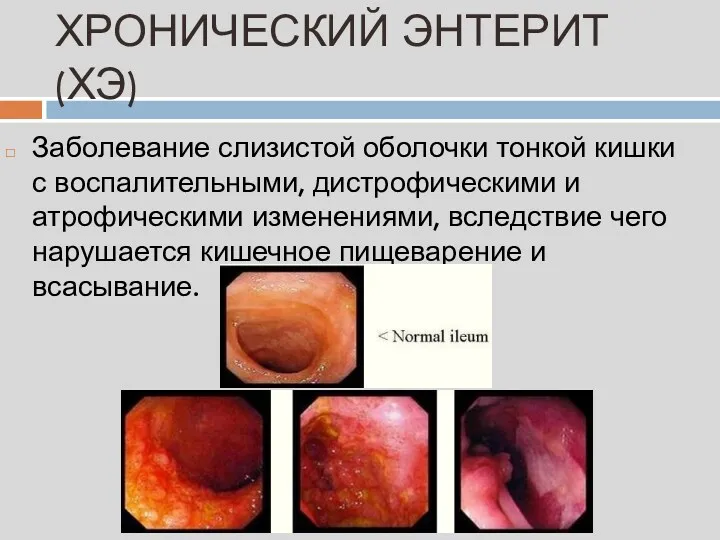 ХРОНИЧЕСКИЙ ЭНТЕРИТ (ХЭ) Заболевание слизистой оболочки тонкой кишки с воспалительными,